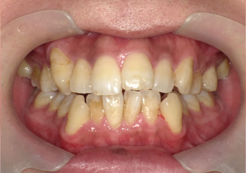 叢生症例_治療前