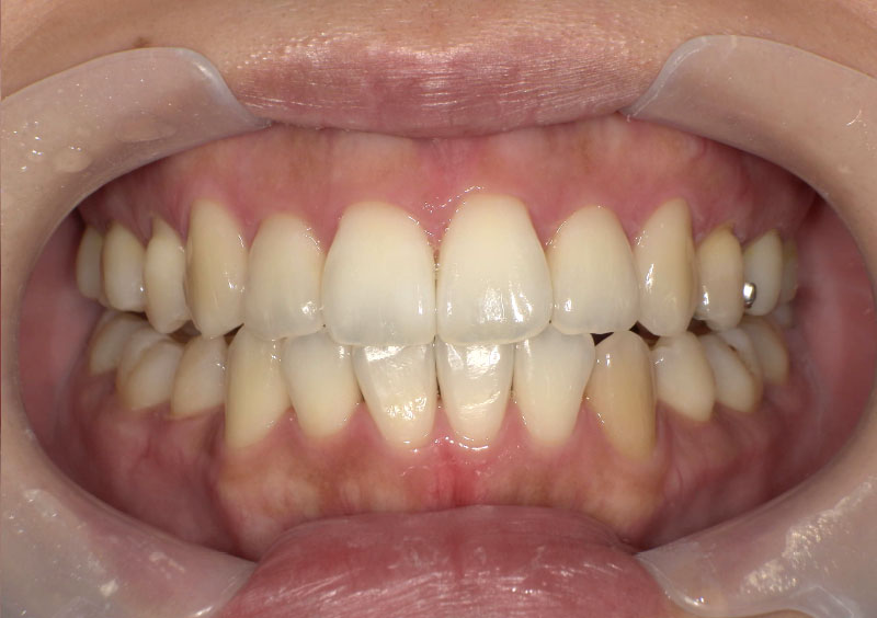 叢生症例_治療前