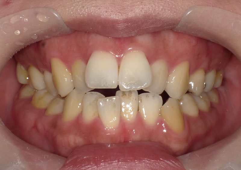 叢生症例_治療前