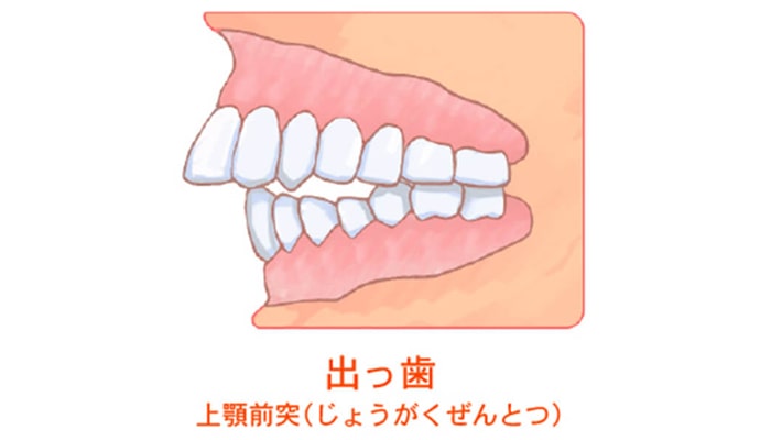 出っ歯(上顎前突)