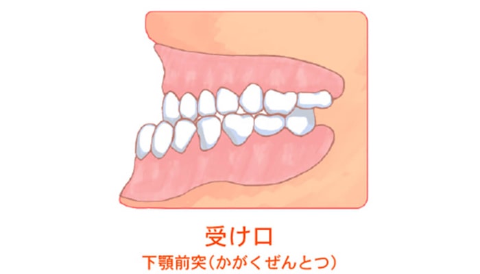 受け口(下顎前突)