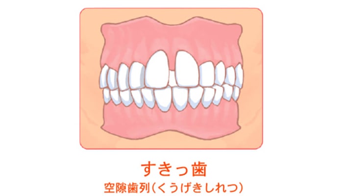 すきっ歯